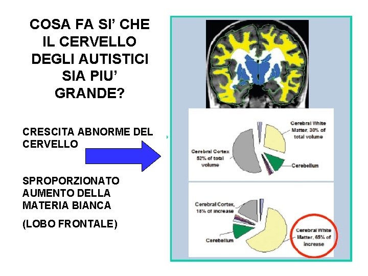 COSA FA SI’ CHE IL CERVELLO DEGLI AUTISTICI SIA PIU’ GRANDE? CRESCITA ABNORME DEL