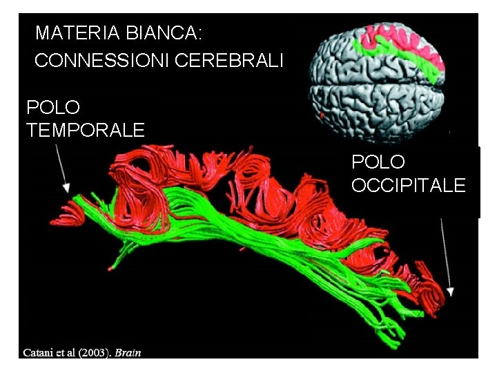 MATERIA BIANCA: CONNESSIONI CEREBRALI POLO TEMPORALE POLO OCCIPITALE 