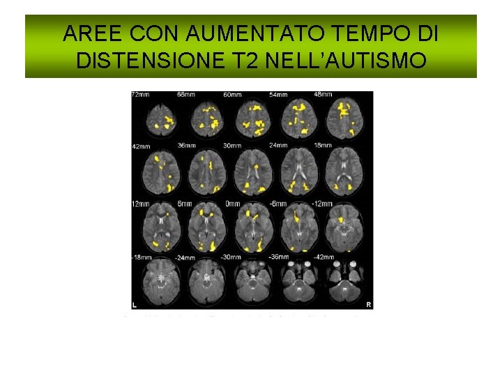 AREE CON AUMENTATO TEMPO DI DISTENSIONE T 2 NELL’AUTISMO 