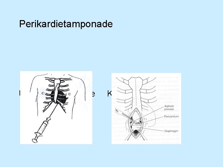 Perikardietamponade UL-vejledt drænage Kir. drænage 