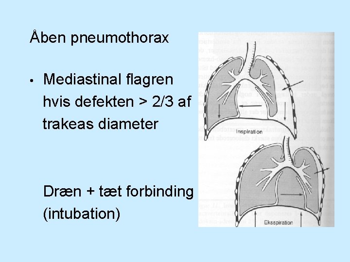 Åben pneumothorax • Mediastinal flagren hvis defekten > 2/3 af trakeas diameter Dræn +