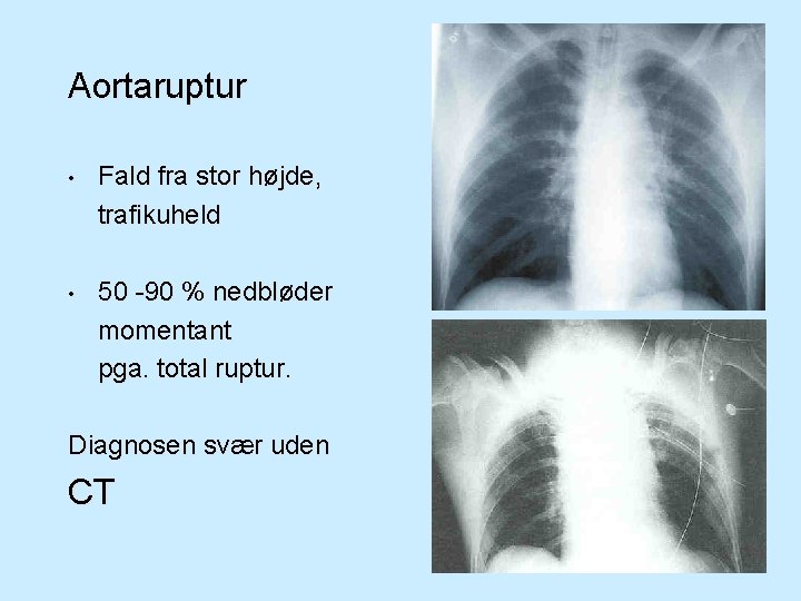 Aortaruptur • Fald fra stor højde, trafikuheld • 50 -90 % nedbløder momentant pga.