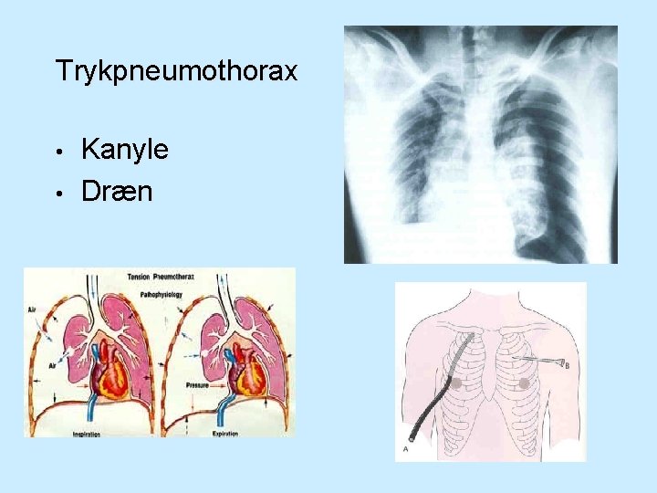 Trykpneumothorax • • Kanyle Dræn 