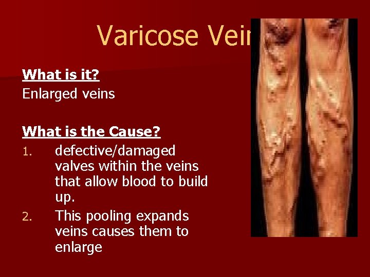 Varicose Veins What is it? Enlarged veins What is the Cause? 1. defective/damaged valves