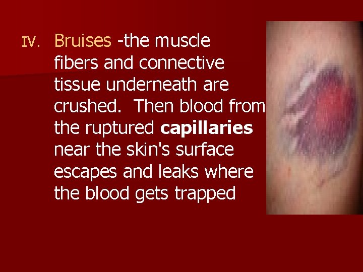 IV. Bruises -the muscle fibers and connective tissue underneath are crushed. Then blood from