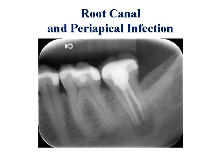 Root Canal and Periapical Infection 