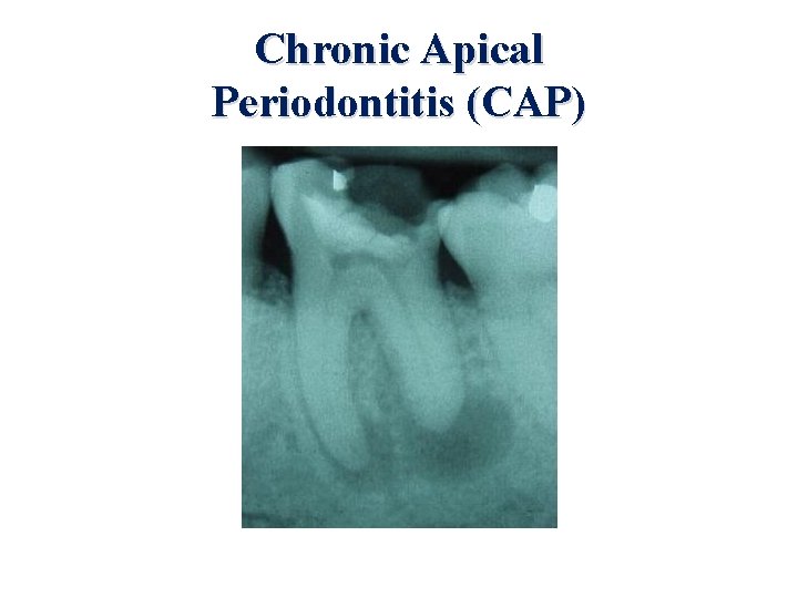 Chronic Apical Periodontitis (CAP) 