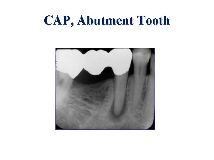 CAP, Abutment Tooth 