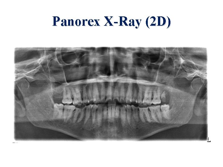 Panorex X-Ray (2 D) 