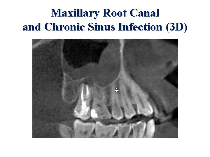 Maxillary Root Canal and Chronic Sinus Infection (3 D) 