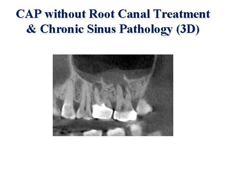 CAP without Root Canal Treatment & Chronic Sinus Pathology (3 D) 