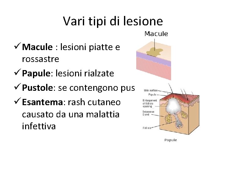 Vari tipi di lesione ü Macule : lesioni piatte e rossastre ü Papule: lesioni