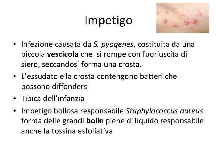 Impetigo • Infezione causata da S. pyogenes, costituita da una piccola vescicola che si