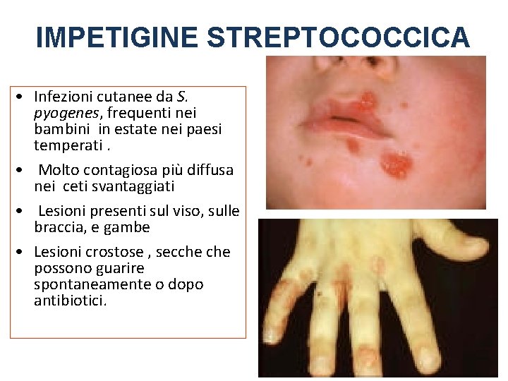 IMPETIGINE STREPTOCOCCICA • Infezioni cutanee da S. pyogenes, frequenti nei bambini in estate nei