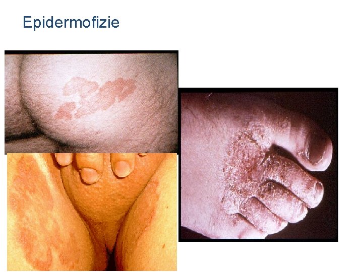 Epidermofizie 