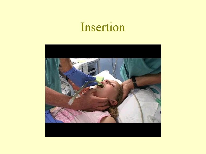 Insertion 