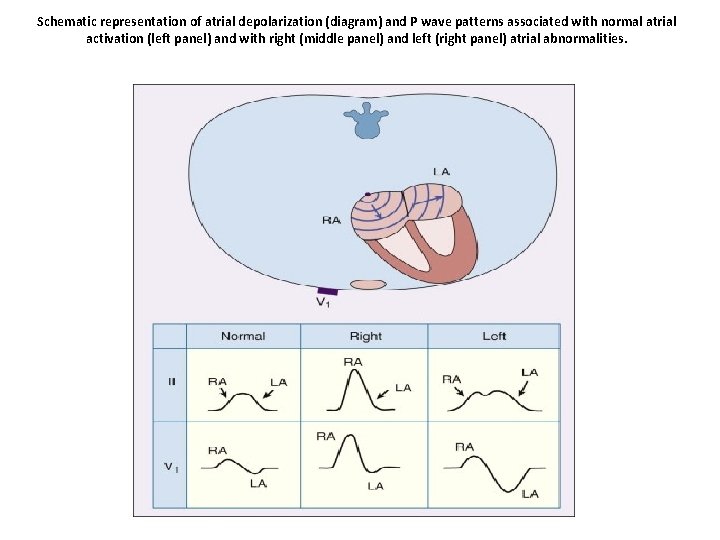 Schematic representation of atrial depolarization (diagram) and P wave patterns associated with normal atrial