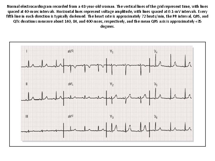 Normal electrocardiogram recorded from a 48 -year-old woman. The vertical lines of the grid