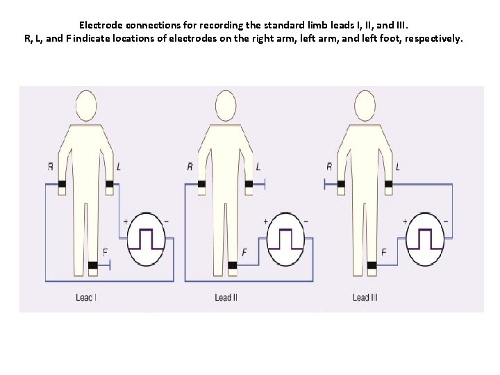 Electrode connections for recording the standard limb leads I, II, and III. R, L,