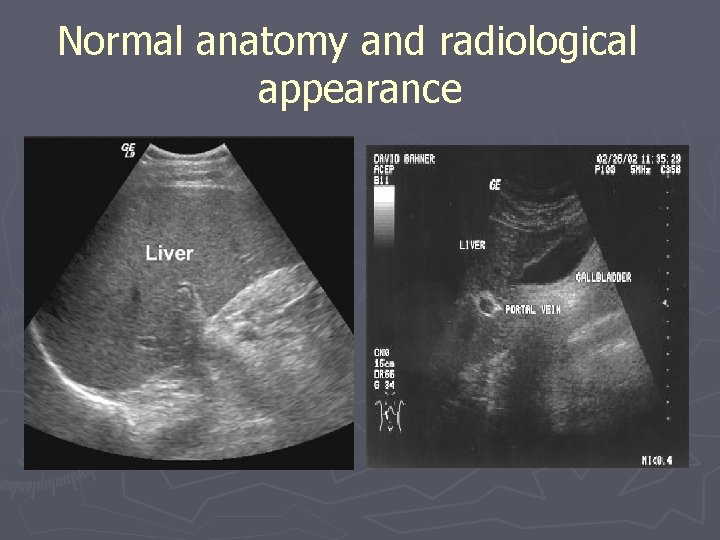 Normal anatomy and radiological appearance Normal anatomy and radiological appearance