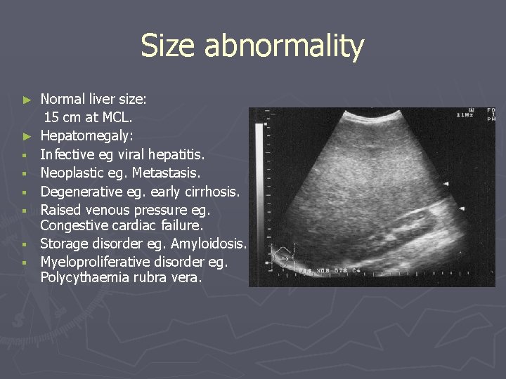Size abnormality ► ► § § § Normal liver size: 15 cm at MCL. Size abnormality ► ► § § § Normal liver size: 15 cm at MCL.
