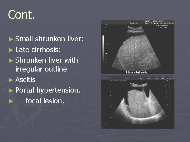 Cont. ► Small shrunken liver: ► Late cirrhosis: ► Shrunken liver with irregular outline Cont. ► Small shrunken liver: ► Late cirrhosis: ► Shrunken liver with irregular outline