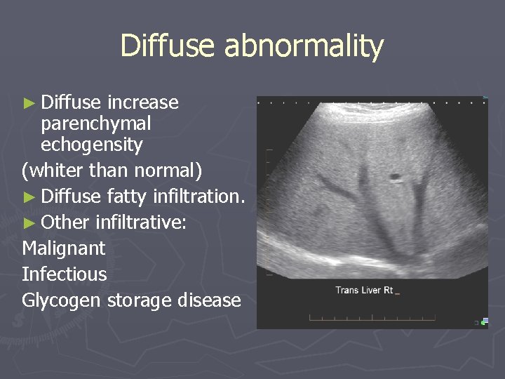 Diffuse abnormality ► Diffuse increase parenchymal echogensity (whiter than normal) ► Diffuse fatty infiltration. Diffuse abnormality ► Diffuse increase parenchymal echogensity (whiter than normal) ► Diffuse fatty infiltration.