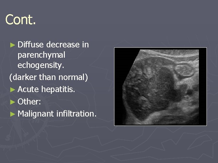 Cont. ► Diffuse decrease in parenchymal echogensity. (darker than normal) ► Acute hepatitis. ► Cont. ► Diffuse decrease in parenchymal echogensity. (darker than normal) ► Acute hepatitis. ►