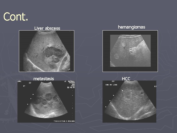 Cont. Liver abscess metastasis hemangiomas HCC Cont. Liver abscess metastasis hemangiomas HCC