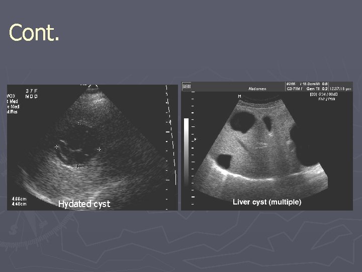 Cont. Hydated cyst Cont. Hydated cyst