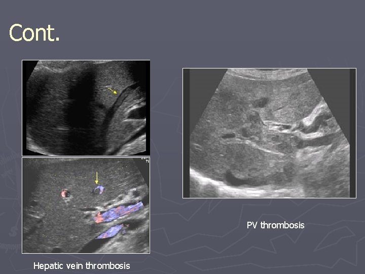 Cont. PV thrombosis Hepatic vein thrombosis Cont. PV thrombosis Hepatic vein thrombosis