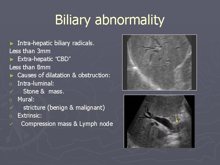 Biliary abnormality Intra-hepatic biliary radicals. Less than 3 mm ► Extra-hepatic “CBD” Less than Biliary abnormality Intra-hepatic biliary radicals. Less than 3 mm ► Extra-hepatic “CBD” Less than