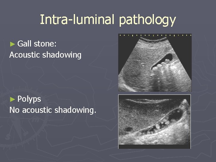 Intra-luminal pathology ► Gall stone: Acoustic shadowing ► Polyps No acoustic shadowing. Intra-luminal pathology ► Gall stone: Acoustic shadowing ► Polyps No acoustic shadowing.