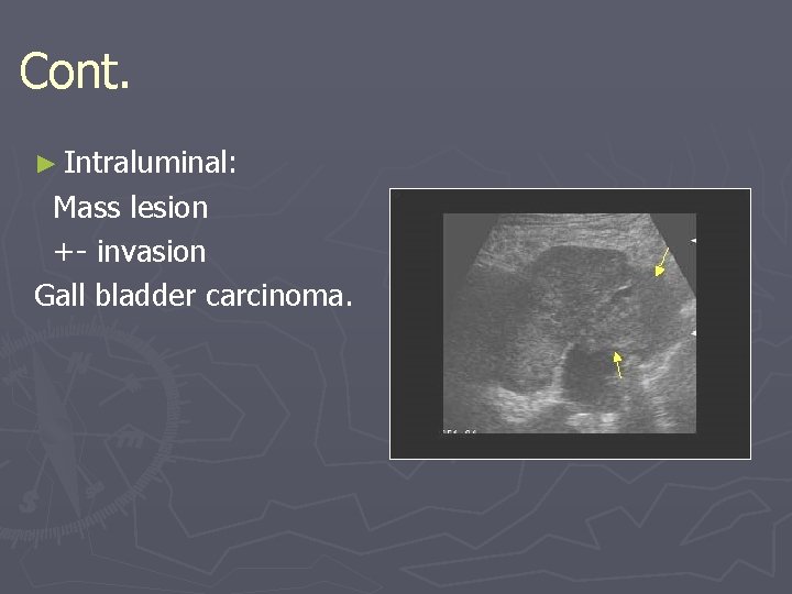 Cont. ► Intraluminal: Mass lesion +- invasion Gall bladder carcinoma. Cont. ► Intraluminal: Mass lesion +- invasion Gall bladder carcinoma.