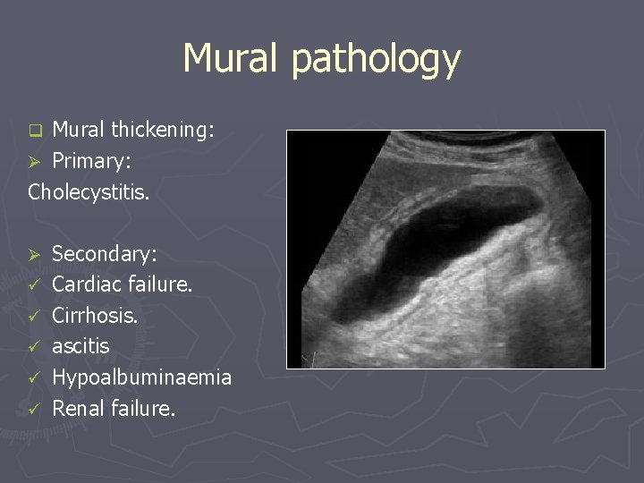 Mural pathology Mural thickening: Ø Primary: Cholecystitis. q Ø ü ü ü Secondary: Cardiac Mural pathology Mural thickening: Ø Primary: Cholecystitis. q Ø ü ü ü Secondary: Cardiac