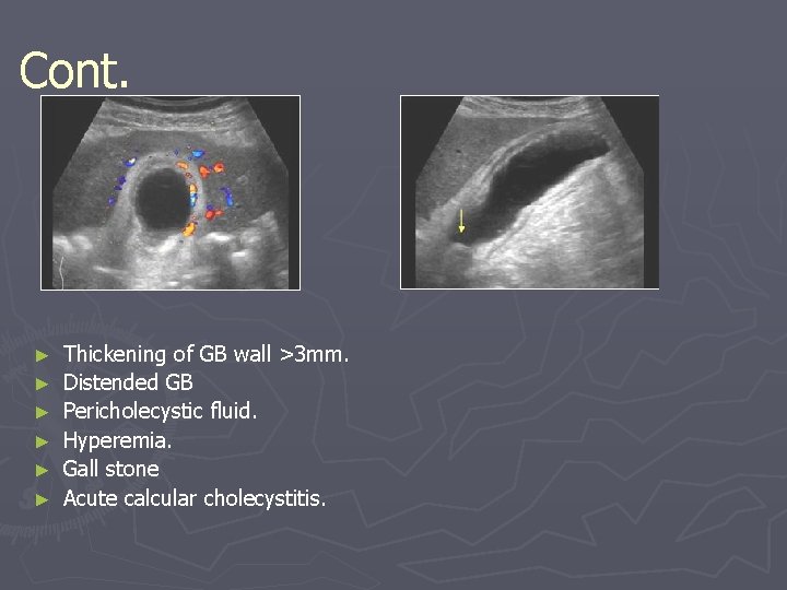 Cont. ► ► ► Thickening of GB wall >3 mm. Distended GB Pericholecystic fluid. Cont. ► ► ► Thickening of GB wall >3 mm. Distended GB Pericholecystic fluid.