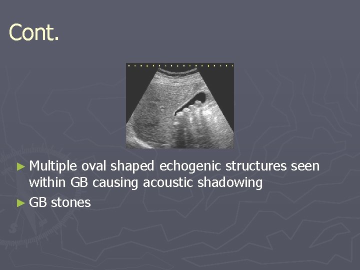 Cont. ► Multiple oval shaped echogenic structures seen within GB causing acoustic shadowing ► Cont. ► Multiple oval shaped echogenic structures seen within GB causing acoustic shadowing ►