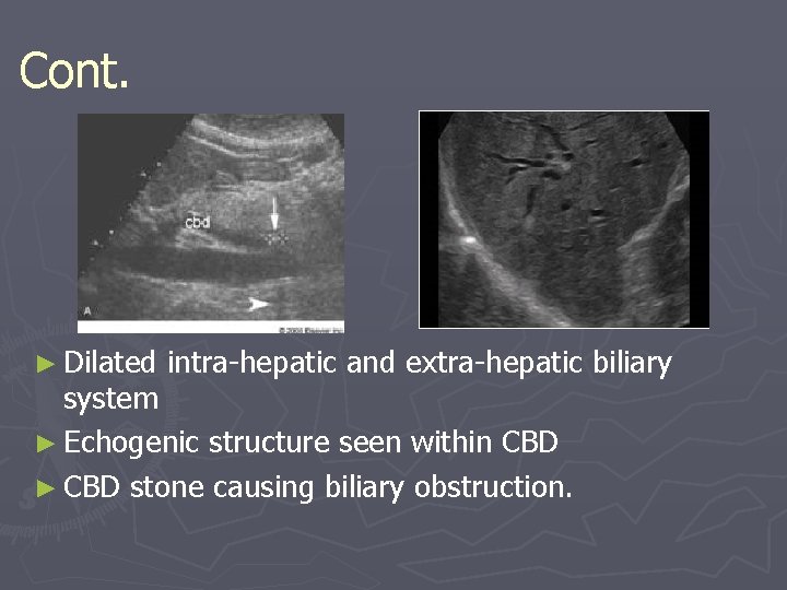 Cont. ► Dilated intra-hepatic and extra-hepatic biliary system ► Echogenic structure seen within CBD Cont. ► Dilated intra-hepatic and extra-hepatic biliary system ► Echogenic structure seen within CBD