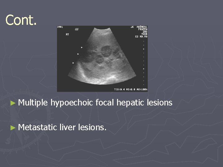 Cont. ► Multiple hypoechoic focal hepatic lesions ► Metastatic liver lesions. Cont. ► Multiple hypoechoic focal hepatic lesions ► Metastatic liver lesions.