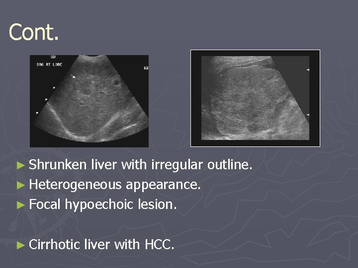 Cont. ► Shrunken liver with irregular outline. ► Heterogeneous appearance. ► Focal hypoechoic lesion. Cont. ► Shrunken liver with irregular outline. ► Heterogeneous appearance. ► Focal hypoechoic lesion.