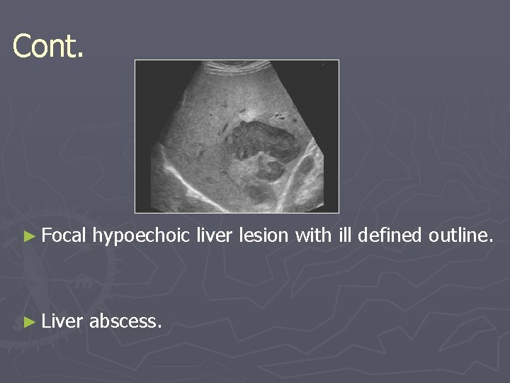 Cont. ► Focal hypoechoic liver lesion with ill defined outline. ► Liver abscess. Cont. ► Focal hypoechoic liver lesion with ill defined outline. ► Liver abscess.