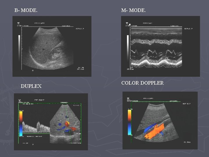 B- MODE. DUPLEX M- MODE. COLOR DOPPLER B- MODE. DUPLEX M- MODE. COLOR DOPPLER