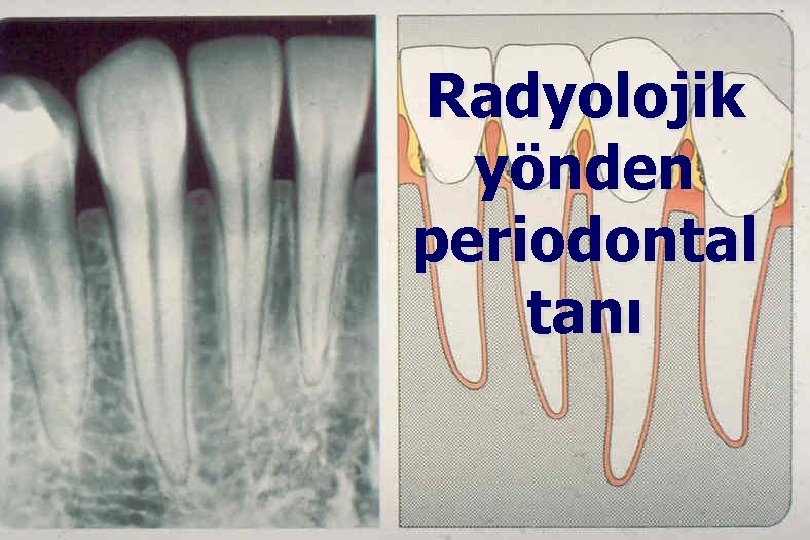 Radyolojik yönden periodontal tanı 