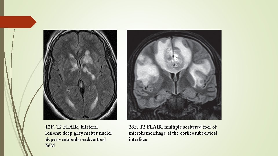 12 F. T 2 FLAIR, bilateral lesions: deep gray matter nuclei & periventricular-subcortical WM