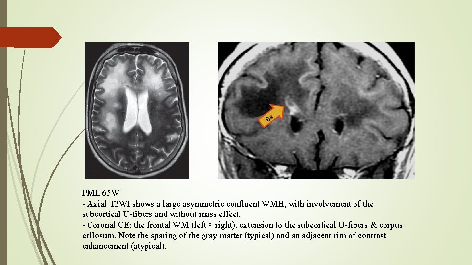 PML 65 W - Axial T 2 WI shows a large asymmetric confluent WMH,