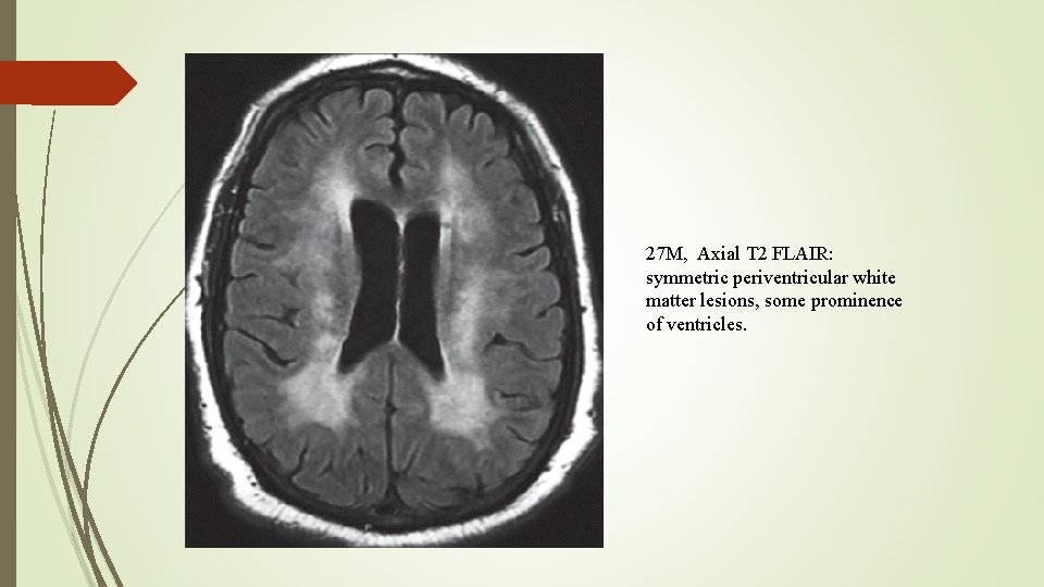 27 M, Axial T 2 FLAIR: symmetric periventricular white matter lesions, some prominence of