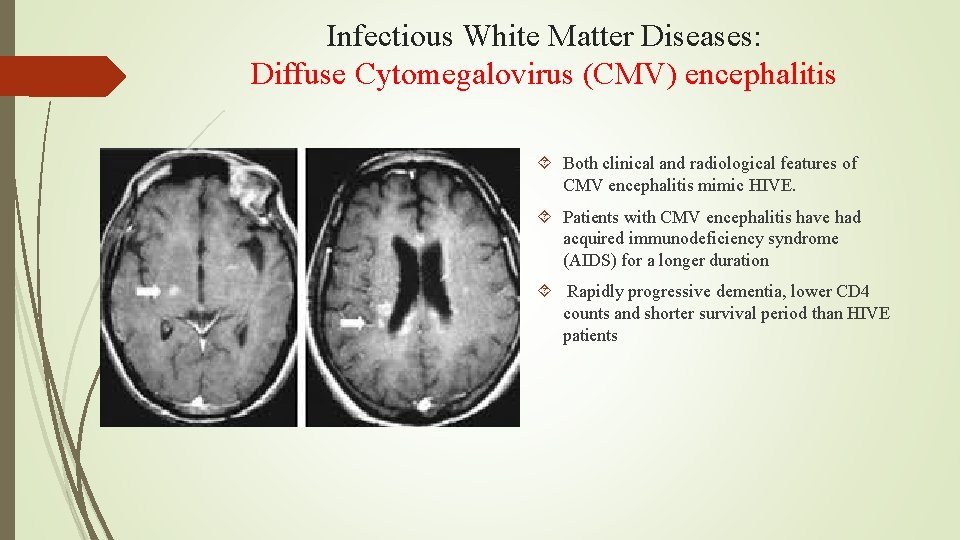 Infectious White Matter Diseases: Diffuse Cytomegalovirus (CMV) encephalitis Both clinical and radiological features of