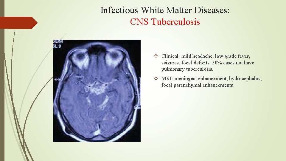 Infectious White Matter Diseases: CNS Tuberculosis Clinical: mild headache, low grade fever, seizures, focal