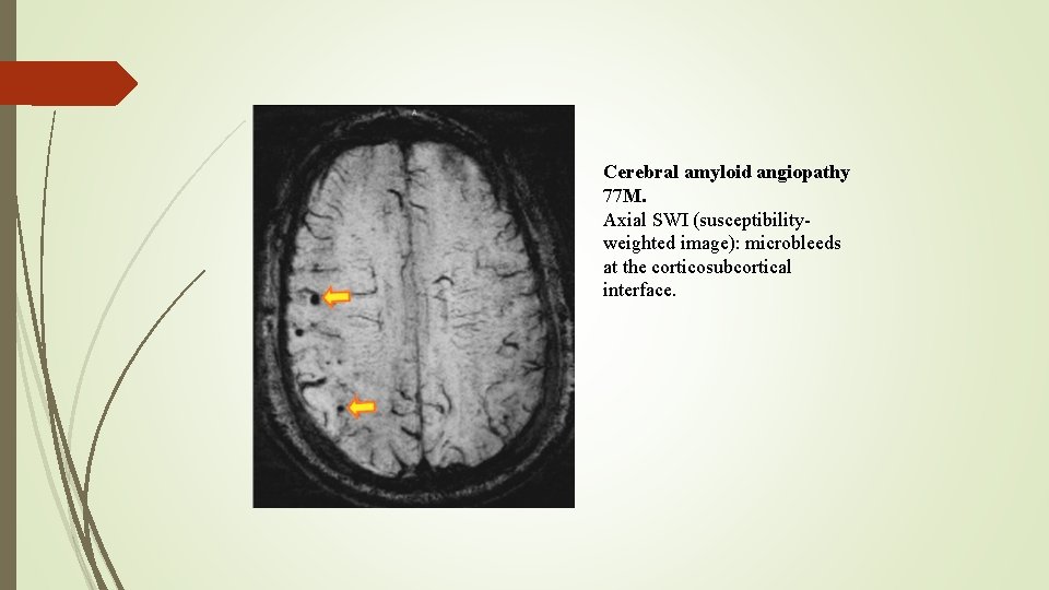 Cerebral amyloid angiopathy 77 M. Axial SWI (susceptibilityweighted image): microbleeds at the corticosubcortical interface.