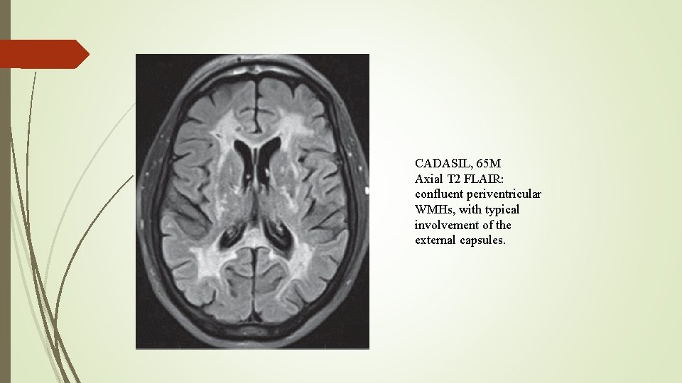 CADASIL, 65 M Axial T 2 FLAIR: confluent periventricular WMHs, with typical involvement of